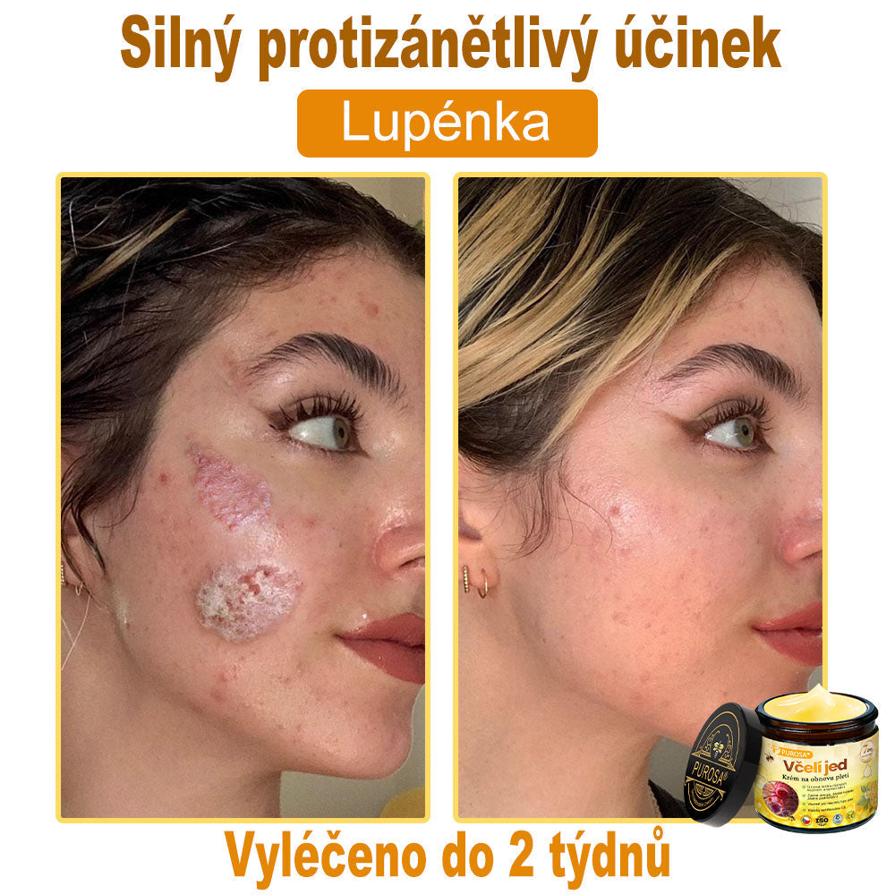 🐝PUROSA® Obnovující krém s včelím jedem｜✅Kompletní řešení pro odolné kožní problémy, jako je stárnutí, ekzém, jizvy a lupénka