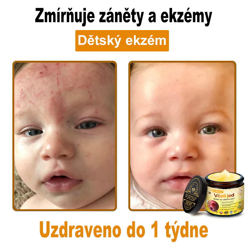 🐝PUROSA® Obnovující krém s včelím jedem｜✅Kompletní řešení pro odolné kožní problémy, jako je stárnutí, ekzém, jizvy a lupénka