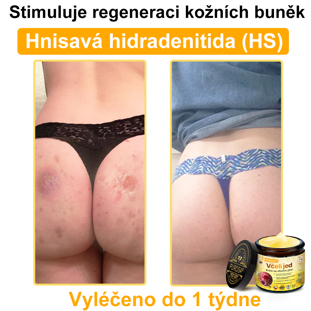 🐝PUROSA® Obnovující krém s včelím jedem｜✅Kompletní řešení pro odolné kožní problémy, jako je stárnutí, ekzém, jizvy a lupénka