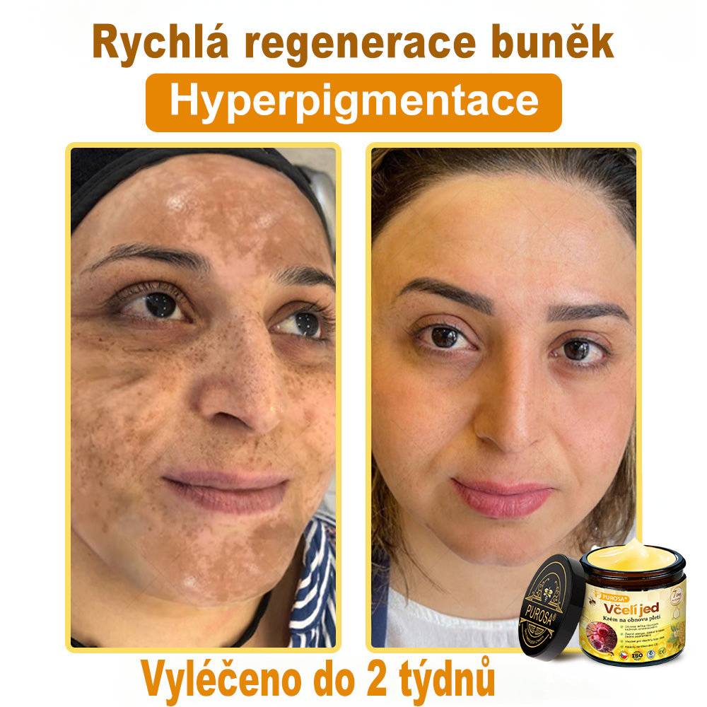 🐝PUROSA® Obnovující krém s včelím jedem｜✅Kompletní řešení pro odolné kožní problémy, jako je stárnutí, ekzém, jizvy a lupénka