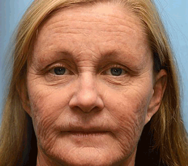 🐝PUROSA® Obnovující krém s včelím jedem｜✅Kompletní řešení pro odolné kožní problémy, jako je stárnutí, ekzém, jizvy a lupénka